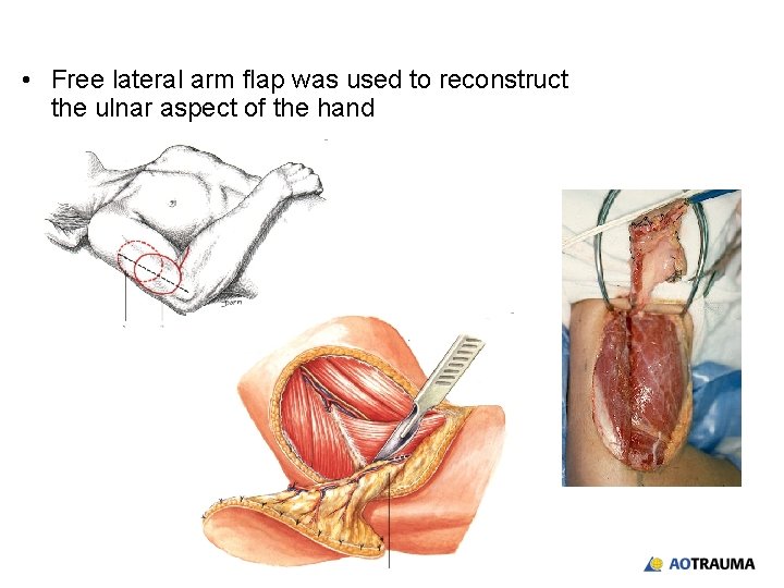  • Free lateral arm flap was used to reconstruct the ulnar aspect of