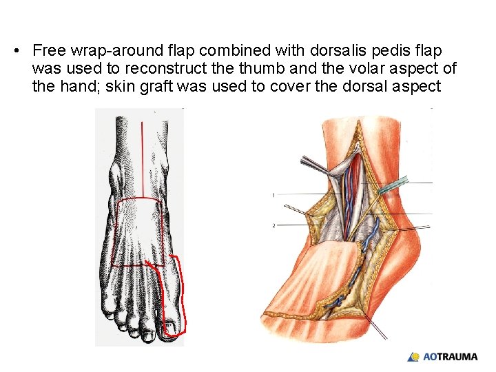  • Free wrap-around flap combined with dorsalis pedis flap was used to reconstruct