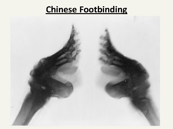 Chinese Footbinding 