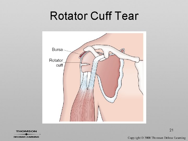 Rotator Cuff Tear 21 