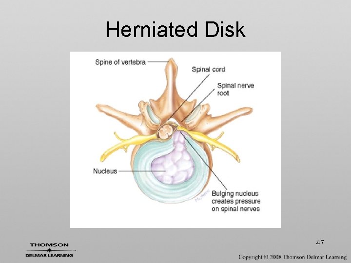 Herniated Disk 47 