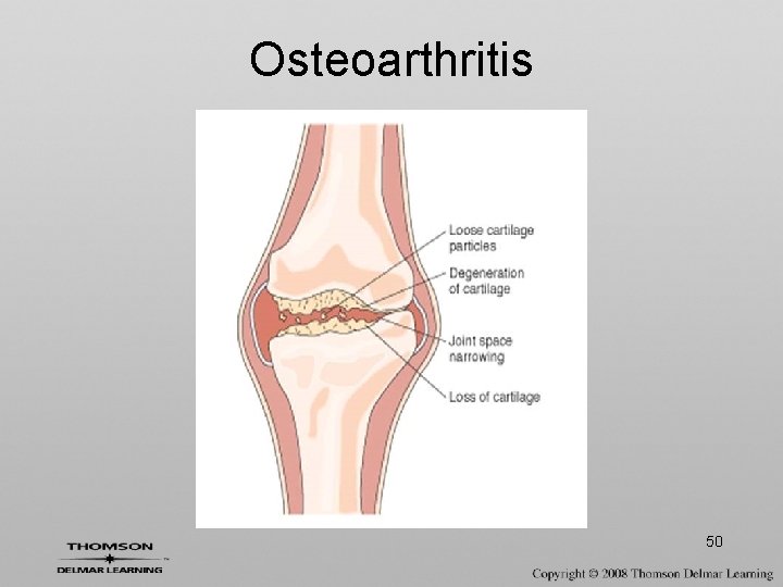 Osteoarthritis 50 