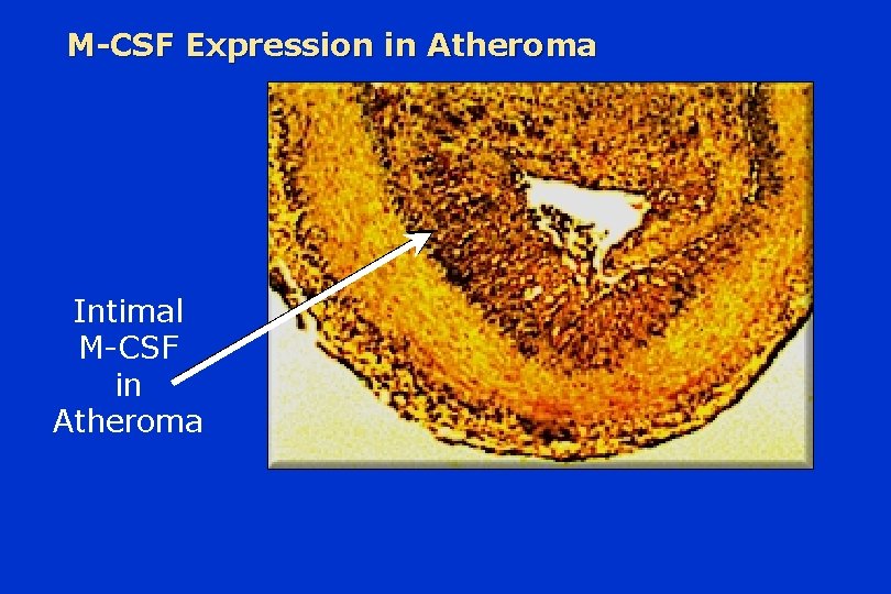 M-CSF Expression in Atheroma Intimal M-CSF in Atheroma 