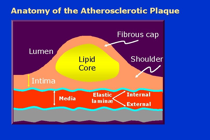 Anatomy of the Atherosclerotic Plaque Fibrous cap Lumen Lipid Core Shoulder Intima Media Elastic