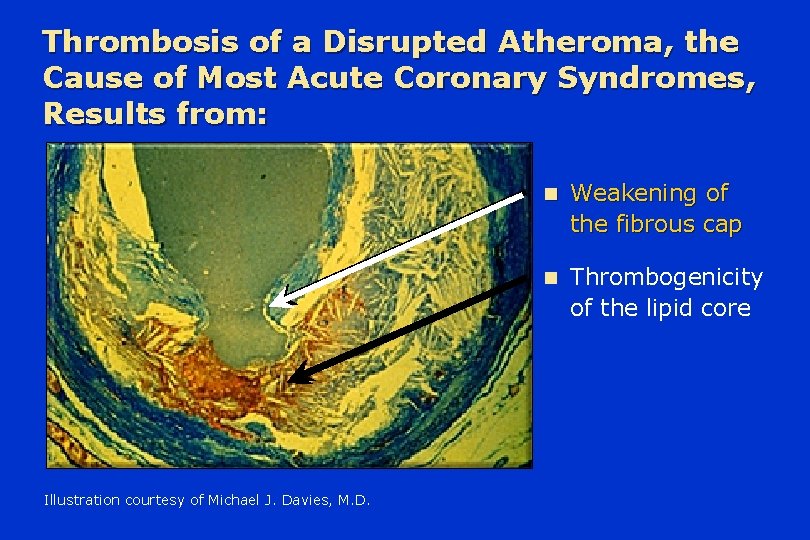 Thrombosis of a Disrupted Atheroma, the Cause of Most Acute Coronary Syndromes, Results from: