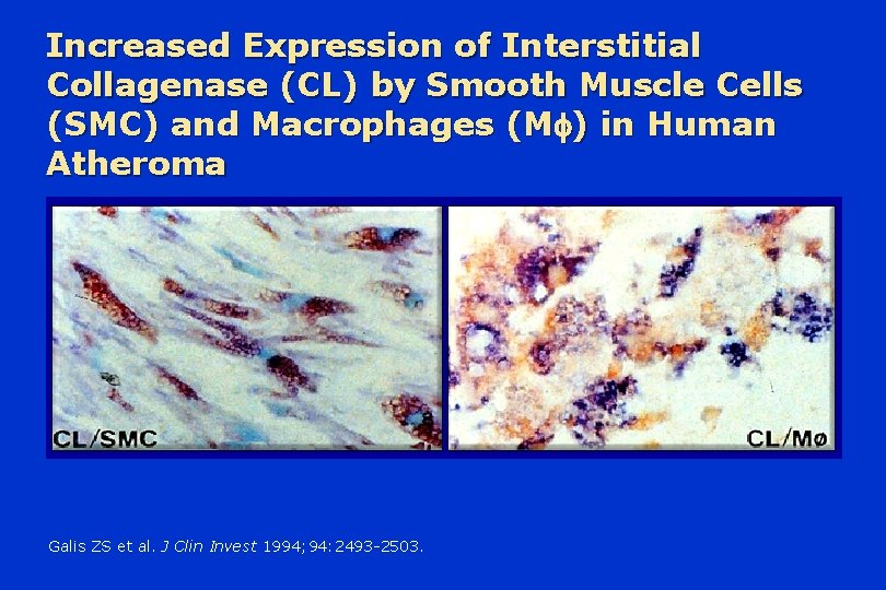 Increased Expression of Interstitial Collagenase (CL) by Smooth Muscle Cells (SMC) and Macrophages (M
