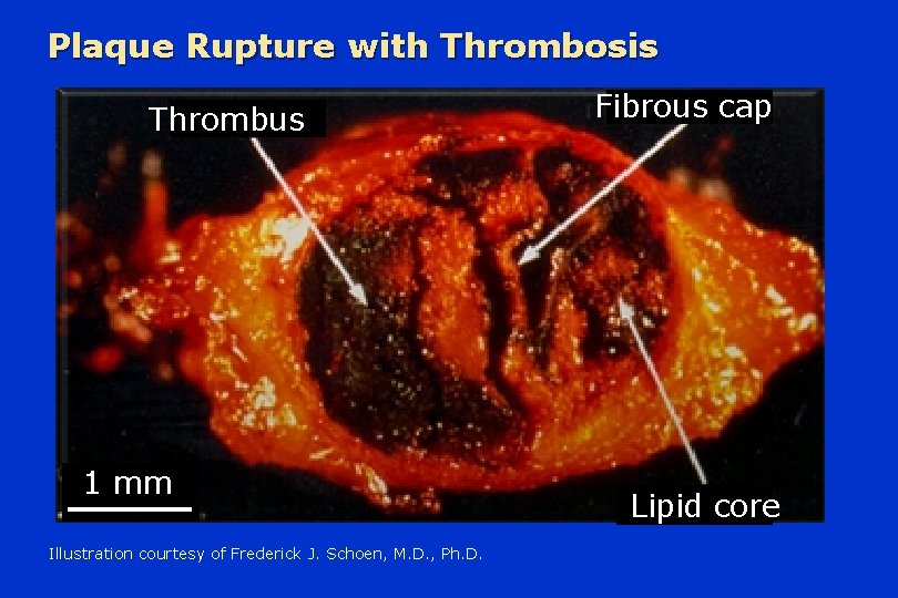 Plaque Rupture with Thrombosis Thrombus 1 mm Illustration courtesy of Frederick J. Schoen, M.