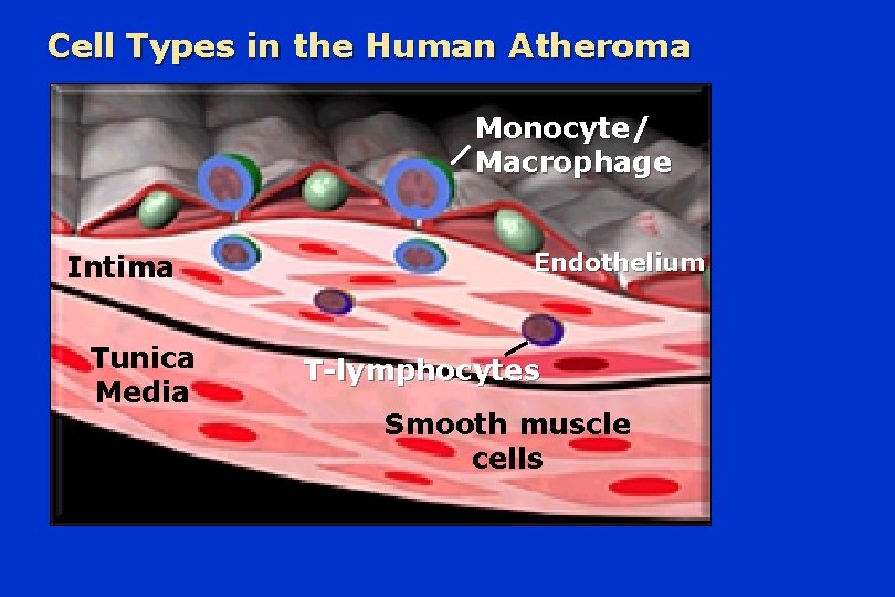 Cell Types in the Human Atheroma Monocyte/ Macrophage Intima Tunica Media Endothelium T-lymphocytes Smooth