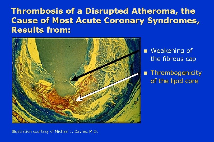 Thrombosis of a Disrupted Atheroma, the Cause of Most Acute Coronary Syndromes, Results from: