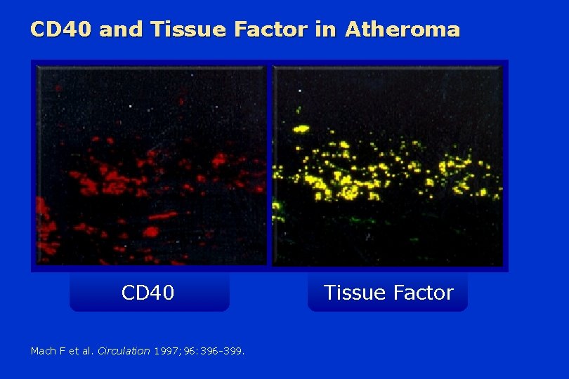 CD 40 and Tissue Factor in Atheroma CD 40 Mach F et al. Circulation