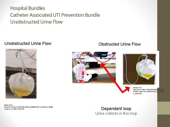 Hospital Bundles Catheter Associated UTI Prevention Bundle Unobstructed Urine Flow Obstructed Urine Flow Photos