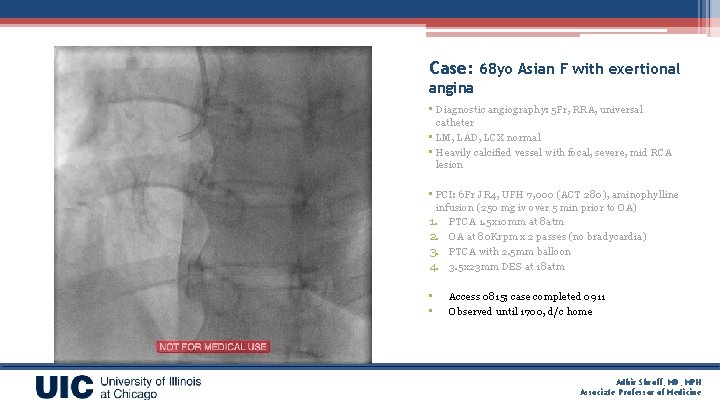 Case: 68 yo Asian F with exertional angina • Diagnostic angiography: 5 Fr, RRA,