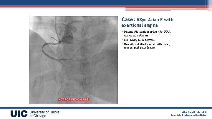 Case: 68 yo Asian F with exertional angina • Diagnostic angiography: 5 Fr, RRA,