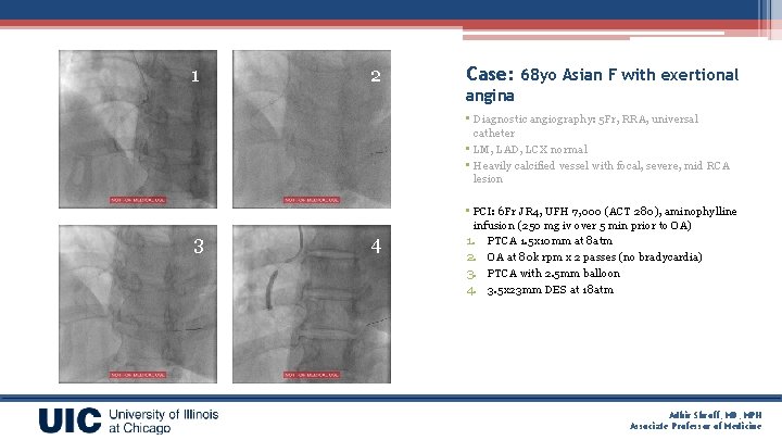 1 2 Case: 68 yo Asian F with exertional angina • Diagnostic angiography: 5