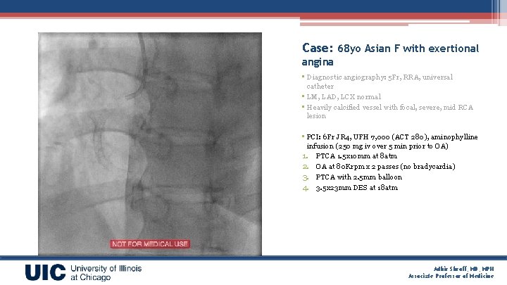 Case: 68 yo Asian F with exertional angina • Diagnostic angiography: 5 Fr, RRA,