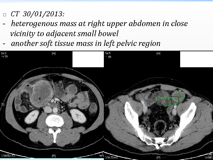 � CT 30/01/2013: - heterogenous mass at right upper abdomen in close vicinity to