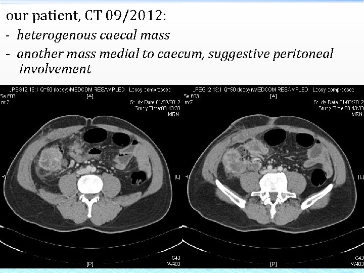 our patient, CT 09/2012: - heterogenous caecal mass - another mass medial to caecum,