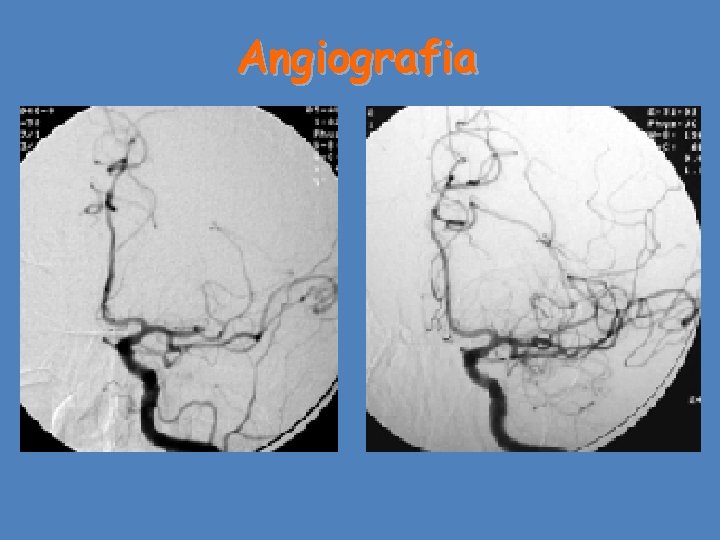 Angiografia 