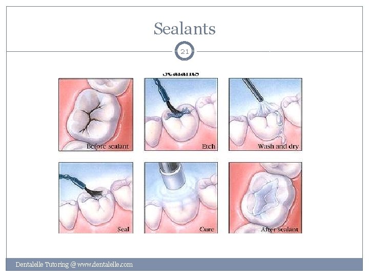 Sealants 21 Dentalelle Tutoring @ www. dentalelle. com 