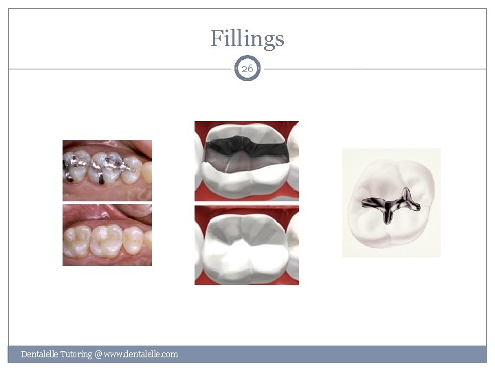 Fillings 26 Dentalelle Tutoring @ www. dentalelle. com 