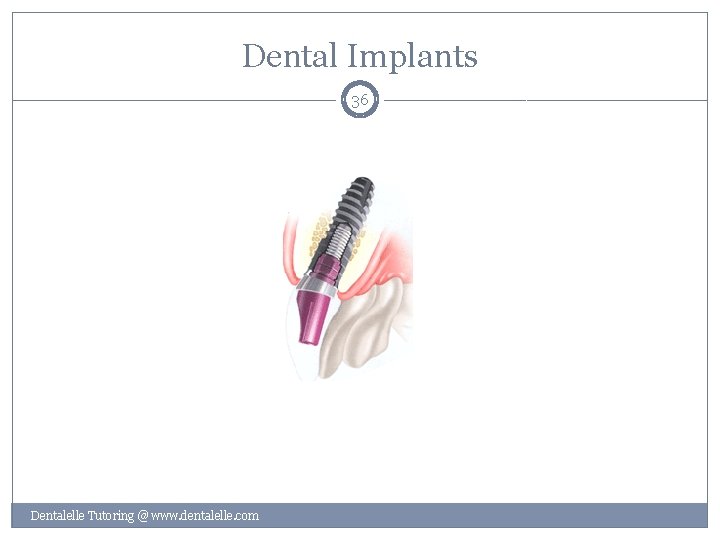 Dental Implants 36 Dentalelle Tutoring @ www. dentalelle. com 