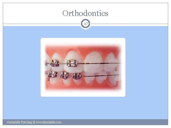 Orthodontics 47 Dentalelle Tutoring @ www. dentalelle. com 