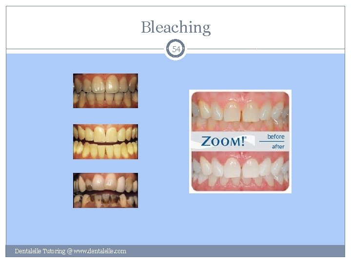 Bleaching 54 Dentalelle Tutoring @ www. dentalelle. com 