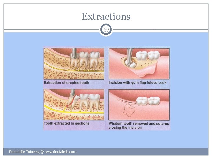 Extractions 59 Dentalelle Tutoring @ www. dentalelle. com 