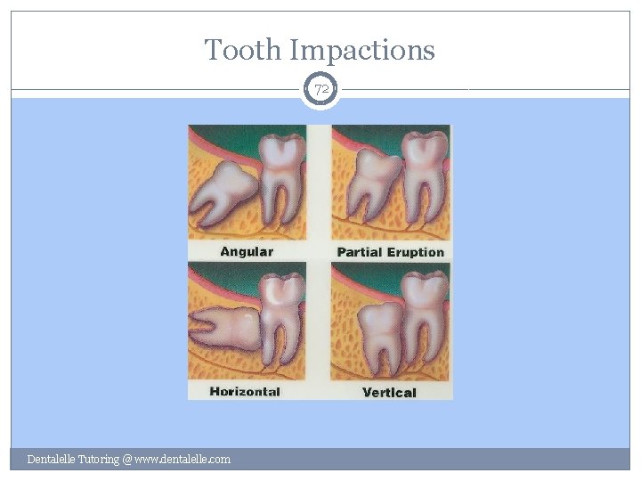 Tooth Impactions 72 Dentalelle Tutoring @ www. dentalelle. com 