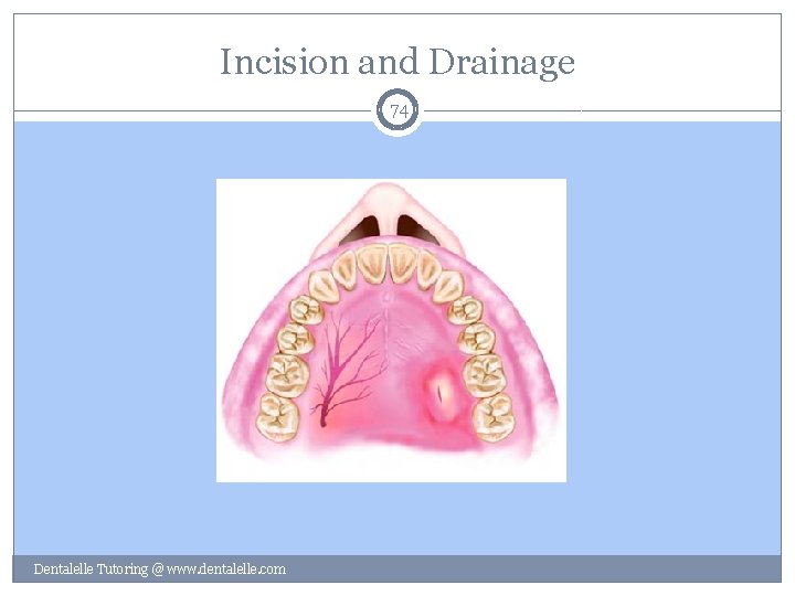 Incision and Drainage 74 Dentalelle Tutoring @ www. dentalelle. com 