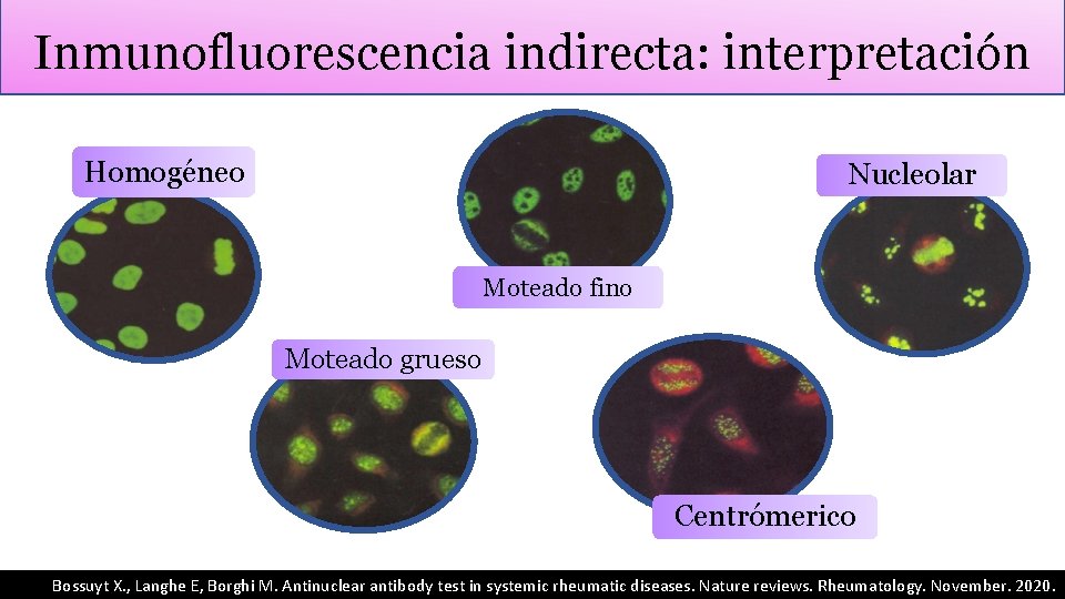 Inmunofluorescencia indirecta: interpretación Homogéneo Nucleolar Moteado fino Moteado grueso Centrómerico Bossuyt X. , Langhe