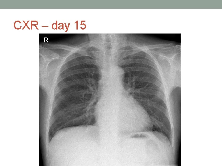 CXR – day 15 