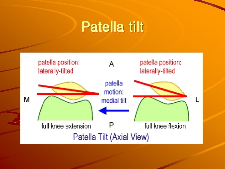 Patella tilt 