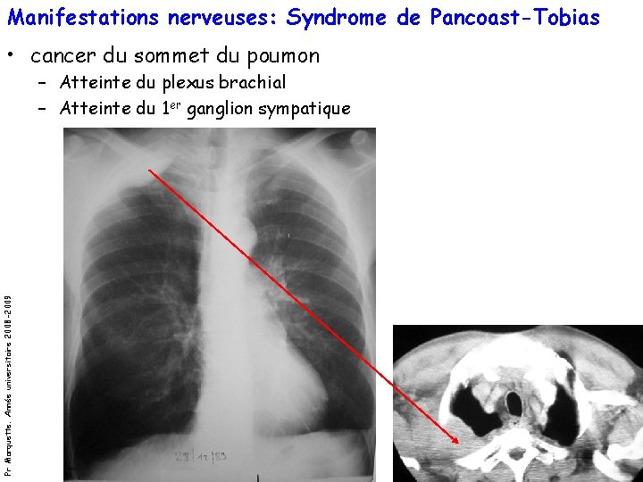 Manifestations nerveuses: Syndrome de Pancoast-Tobias • cancer du sommet du poumon Pr Marquette. Année