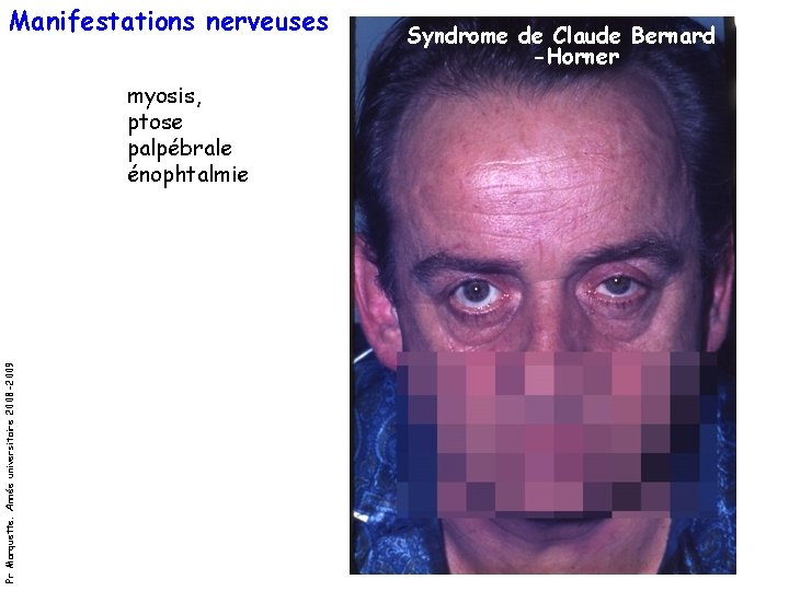 Manifestations nerveuses Pr Marquette. Année universitaire 2008 -2009 myosis, ptose palpébrale énophtalmie Syndrome de