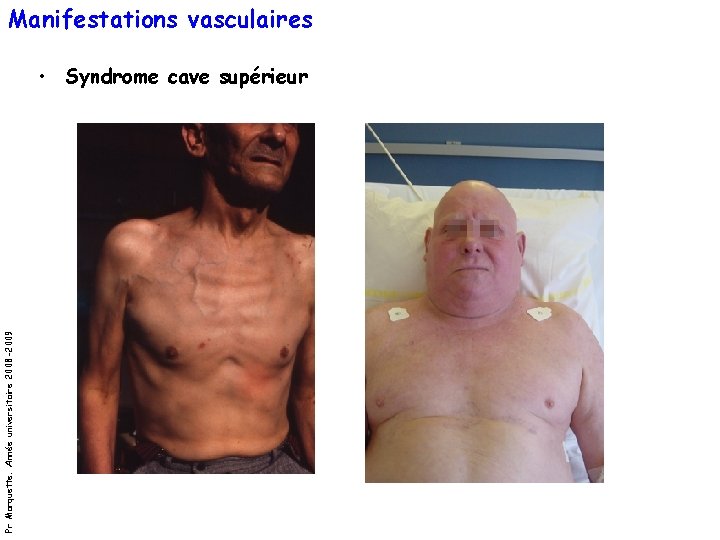 Manifestations vasculaires Pr Marquette. Année universitaire 2008 -2009 • Syndrome cave supérieur Manifestations vasculaires Pr Marquette. Année universitaire 2008 -2009 • Syndrome cave supérieur