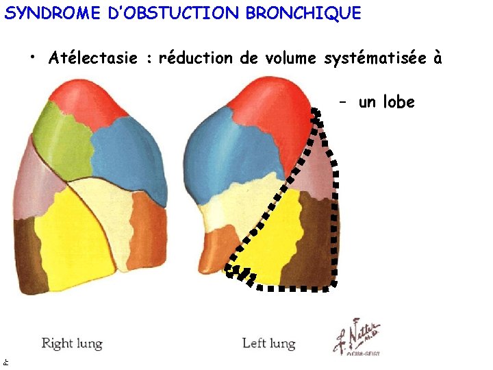 SYNDROME D’OBSTUCTION BRONCHIQUE • Atélectasie : réduction de volume systématisée à Pr Marquette. Année