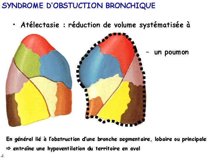 SYNDROME D’OBSTUCTION BRONCHIQUE • Atélectasie : réduction de volume systématisée à Pr Marquette. Année