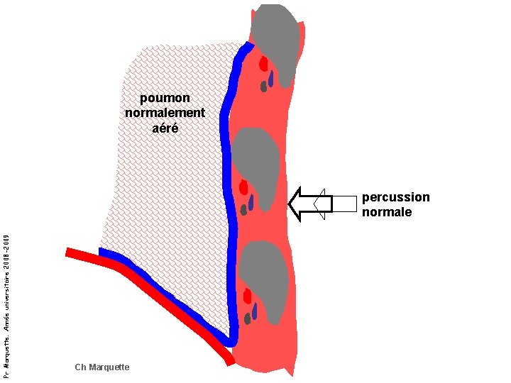 poumon normalement aéré Pr Marquette. Année universitaire 2008 -2009 percussion normale Ch Marquette poumon normalement aéré Pr Marquette. Année universitaire 2008 -2009 percussion normale Ch Marquette