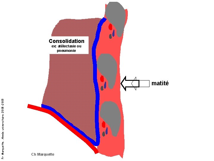 Consolidation ex: atélectasie ou pneumonie Pr Marquette. Année universitaire 2008 -2009 matité Ch Marquette
