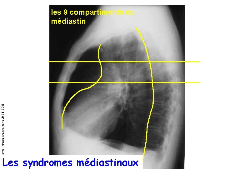 Pr Marquette. Année universitaire 2008 -2009 les 9 compartiments du médiastin Les syndromes médiastinaux