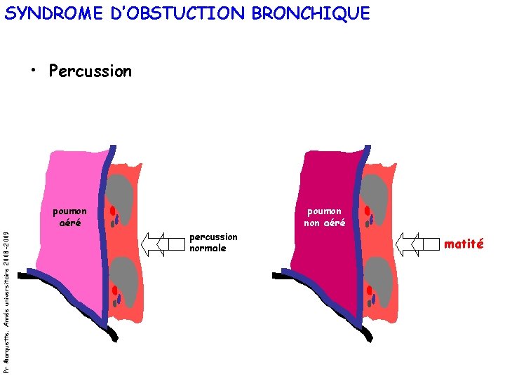 SYNDROME D’OBSTUCTION BRONCHIQUE • Percussion Pr Marquette. Année universitaire 2008 -2009 poumon aéré poumon