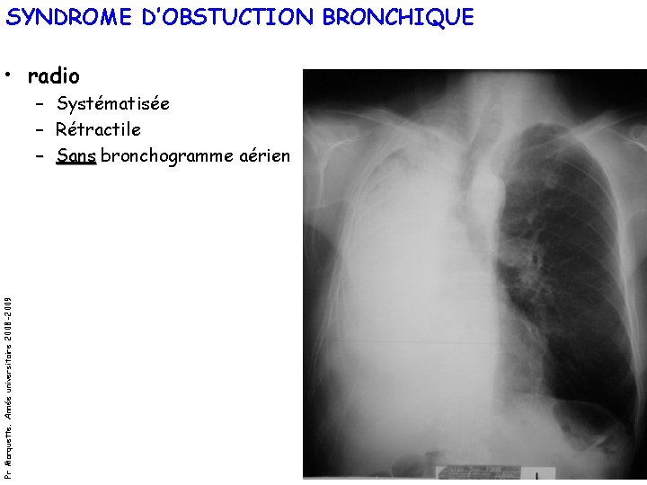 SYNDROME D’OBSTUCTION BRONCHIQUE • radio Pr Marquette. Année universitaire 2008 -2009 – – –