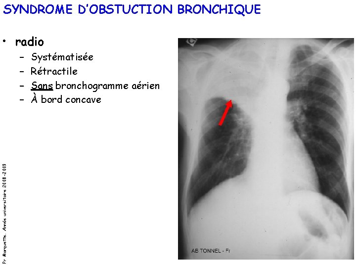 SYNDROME D’OBSTUCTION BRONCHIQUE • radio Pr Marquette. Année universitaire 2008 -2009 – – Systématisée SYNDROME D’OBSTUCTION BRONCHIQUE • radio Pr Marquette. Année universitaire 2008 -2009 – – Systématisée