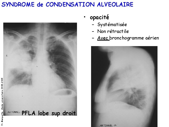 SYNDROME de CONDENSATION ALVEOLAIRE • opacité Pr Marquette. Année universitaire 2008 -2009 – Systématisée