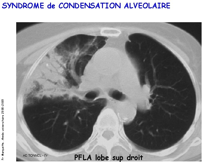 Pr Marquette. Année universitaire 2008 -2009 SYNDROME de CONDENSATION ALVEOLAIRE PFLA lobe sup droit