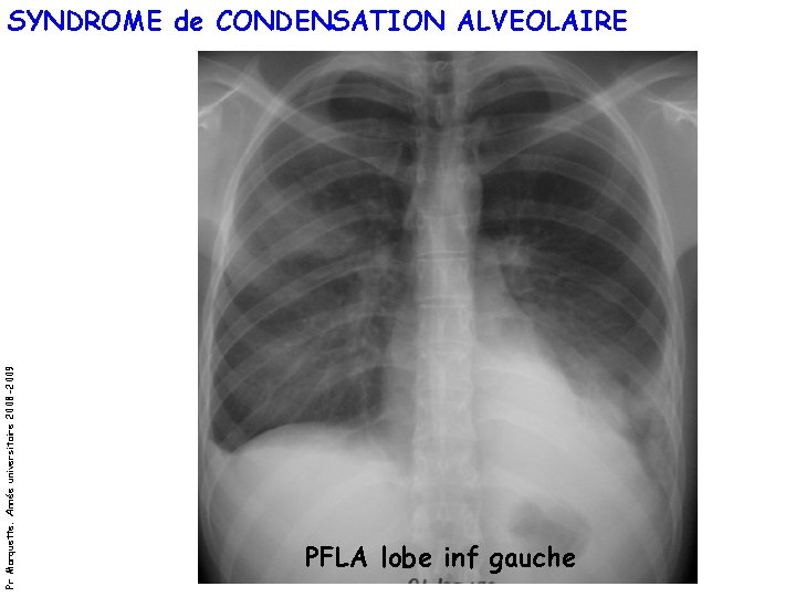 Pr Marquette. Année universitaire 2008 -2009 SYNDROME de CONDENSATION ALVEOLAIRE PFLA lobe inf gauche