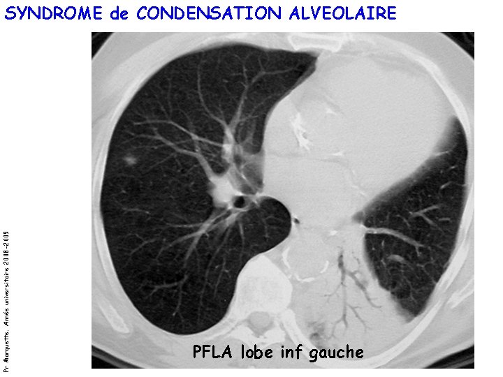 Pr Marquette. Année universitaire 2008 -2009 SYNDROME de CONDENSATION ALVEOLAIRE PFLA lobe inf gauche