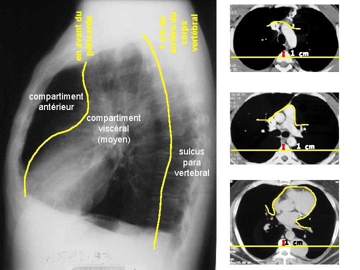Pr Marquette. Année universitaire 2008 -2009 compartiment viscéral (moyen) sulcus para vertebral 1 cm Pr Marquette. Année universitaire 2008 -2009 compartiment viscéral (moyen) sulcus para vertebral 1 cm