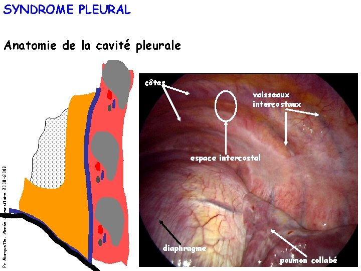 SYNDROME PLEURAL Anatomie de la cavité pleurale côtes vaisseaux intercostaux Pr Marquette. Année universitaire